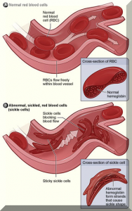 Sickle Cell Anemia Curable Via Nutrition